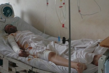 Thai phụ bỏng nặng vì cầm chai xăng cạnh đống than