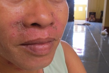 Cả khu dân cư lo sợ vì nghi “côn trùng lạ” tấn công