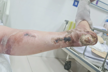 Nữ bệnh nhân phải cắt cụt chi vì biến chứng đái tháo đường