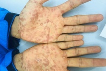 Hơn một nửa số ca mắc bệnh lây truyền qua đường tình dục xảy ra ở người trẻ