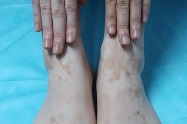 Kỳ lạ cô gái bỗng nhiên đổi màu tay chân vì chữa ra mồ hôi bằng lá trầu không