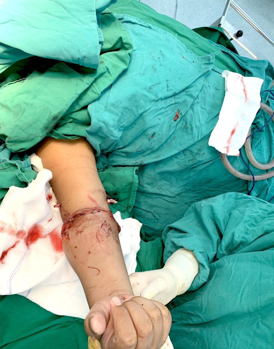 Bệnh nhi 8 tuổi nhập viện với cẳng tay… ướp trong thùng đá - 2 Bệnh nhi 8 tuổi nhập viện với cẳng tay… ướp trong thùng đá - 2