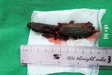 Bé trai 8 tuổi bị khúc gỗ đâm xuyên mũi