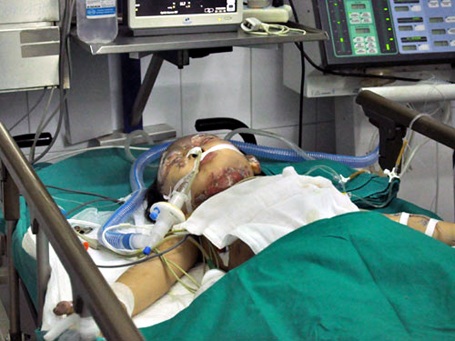Em bé vụ nổ xe máy có thể bị bỏng hô hấp
