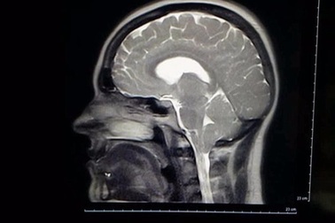 Không dám cười to vì sợ... thủng màng não