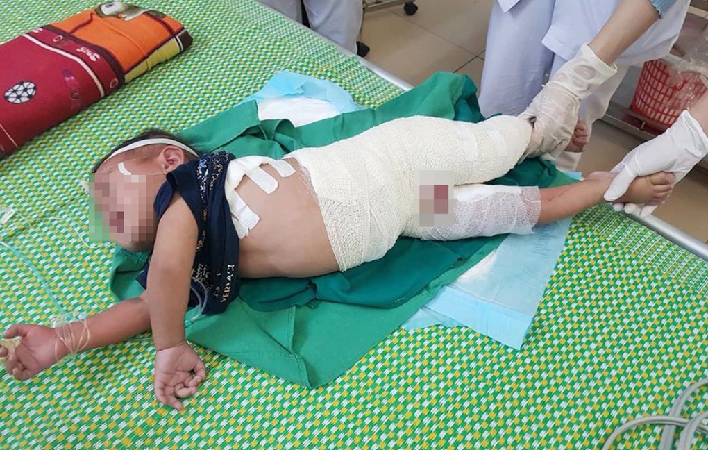 Bé 5 tuổi nhiễm trùng nặng, nôn ra máu khi đắp lá thuốc chữa bỏng - 1 Bé 5 tuổi nhiễm trùng nặng, nôn ra máu khi đắp lá thuốc chữa bỏng - 1