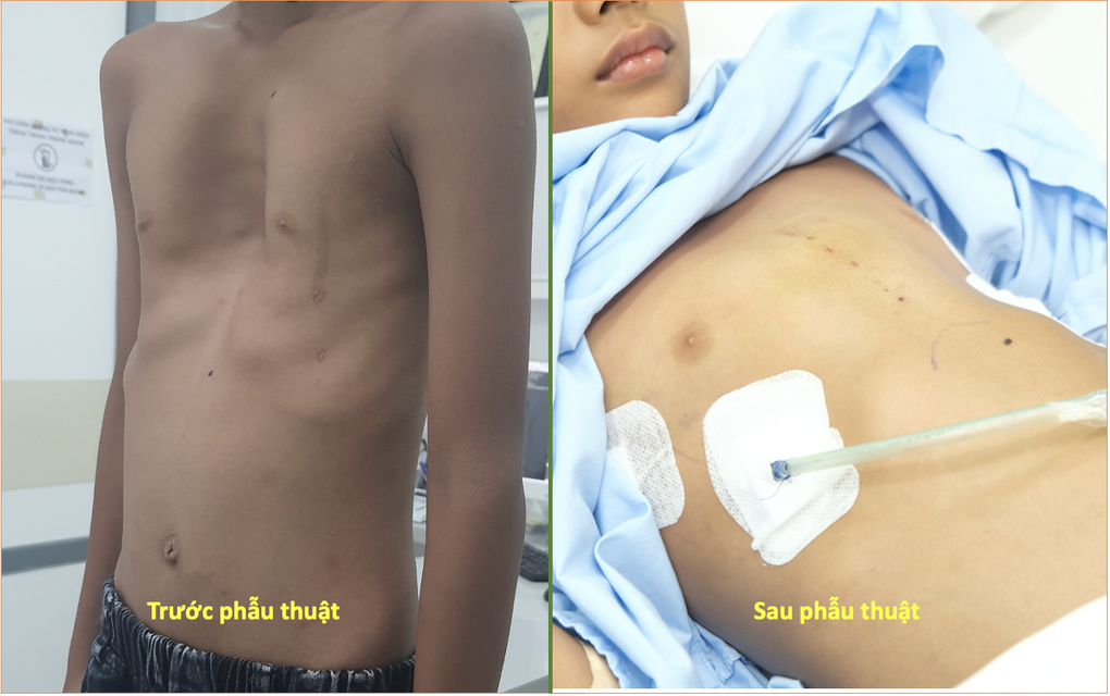 Phẫu thuật tái tạo lồng ngực cho bé trai 9 tuổi bị lõm ngực bẩm sinh nặng - 1 Phẫu thuật tái tạo lồng ngực cho bé trai 9 tuổi bị lõm ngực bẩm sinh nặng - 1