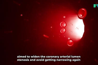 Cứu sống bệnh nhân 82 tuổi bị đột quỵ và hẹp động mạch vành