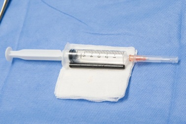 Người đàn ông bị hàng xóm dùng đũa đâm xuyên từ vùng mắt đến hốc mũi