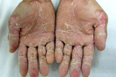 Chuyên gia lại vào cuộc nghiên cứu bệnh “lạ” ở Quảng Ngãi