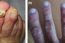 5 dấu hiệu trên da cảnh báo bạn có nguy cơ mắc Covid-19