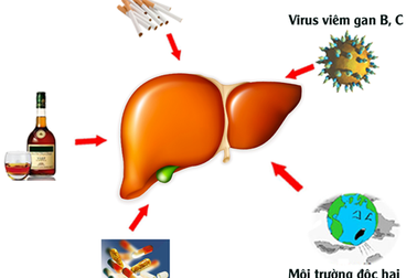 Video tư vấn: Những hiểu lầm thường gặp về nóng gan
