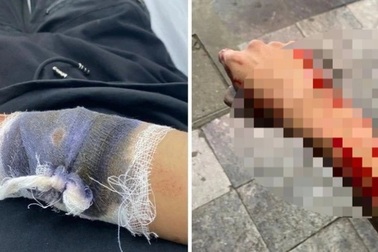 Thiếu niên bị chém, cướp xe máy trước Nhà hát Lớn Hà Nội