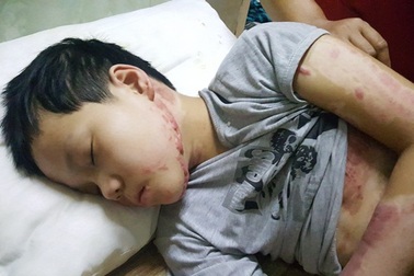 Cháu bé nướng khoai bị bỏng nặng đã được xuất viện về nhà