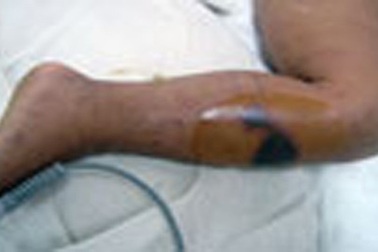 Bé 3 tuổi suýt chết vì bị rắn hổ mèo cắn 