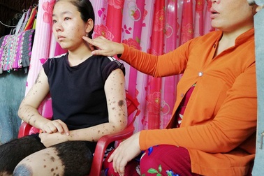 Khốn khổ bé gái lớp 8 mắc bệnh rối loạn sắc tố da