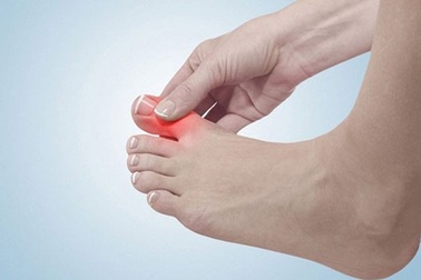 Bạn có hiểu sai về bệnh gout?