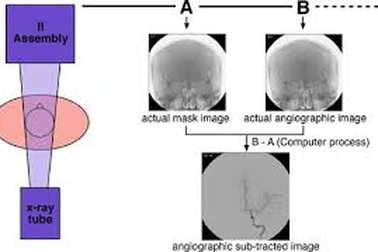 DSA: Thủ thuật “vàng” trong điều trị tim mạch