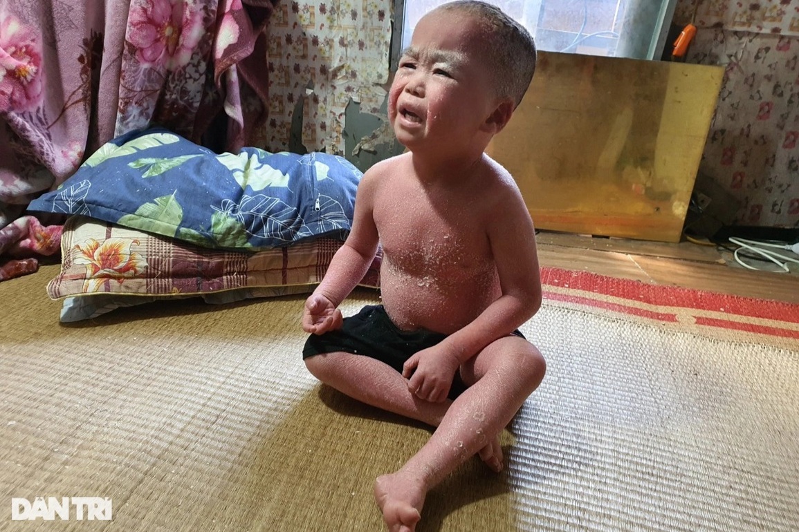 Thương bé trai 5 tuổi mắc căn bệnh kỳ lạ, đau đớn khóc thét mỗi lần mặc áo - 6 Thương bé trai 5 tuổi mắc căn bệnh kỳ lạ, đau đớn khóc thét mỗi lần mặc áo - 6