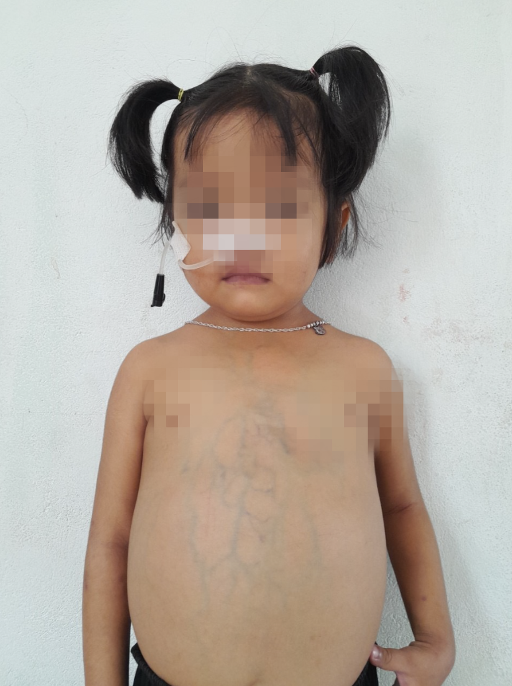 Bé gái 3 tuổi mắc hội chứng hiếm gặp được ghép gan thành công - 1 Bé gái 3 tuổi mắc hội chứng hiếm gặp được ghép gan thành công - 1