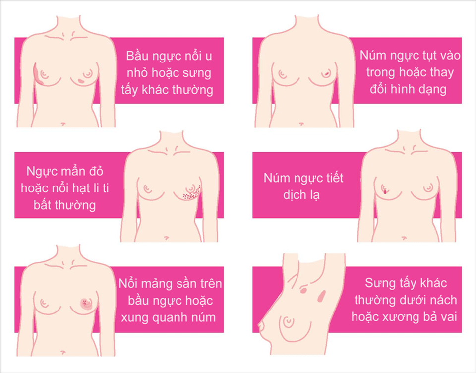 Ung thư vú: Các yếu tố nguy cơ, dấu hiệu và chẩn đoán - 2 Ung thư vú: Các yếu tố nguy cơ, dấu hiệu và chẩn đoán - 2