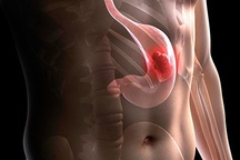 Nguyên nhân ung thư dạ dày đứng thứ 3 tại Việt Nam