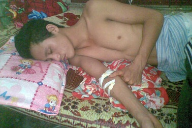 Vỡ nền sọ, dập não vì vướng phải dây diều 