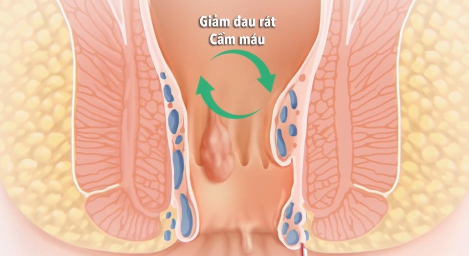 Bệnh trĩ - Cách phòng tránh và chữa trị - 2 Bệnh trĩ - Cách phòng tránh và chữa trị - 2