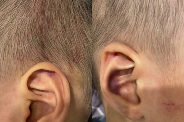 Công an điều tra vụ bé trai 2 tuổi nghi bị cô giáo đánh tím đầu