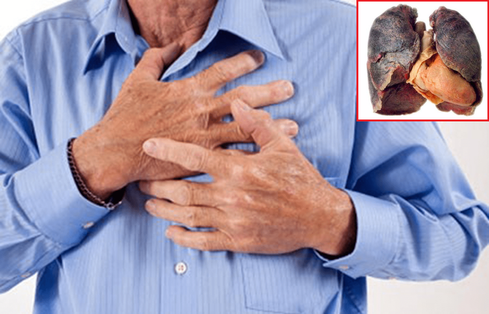Bệnh nhân ung thư phổi cần lưu ý điều gì sau khi kết thúc điều trị? - 1