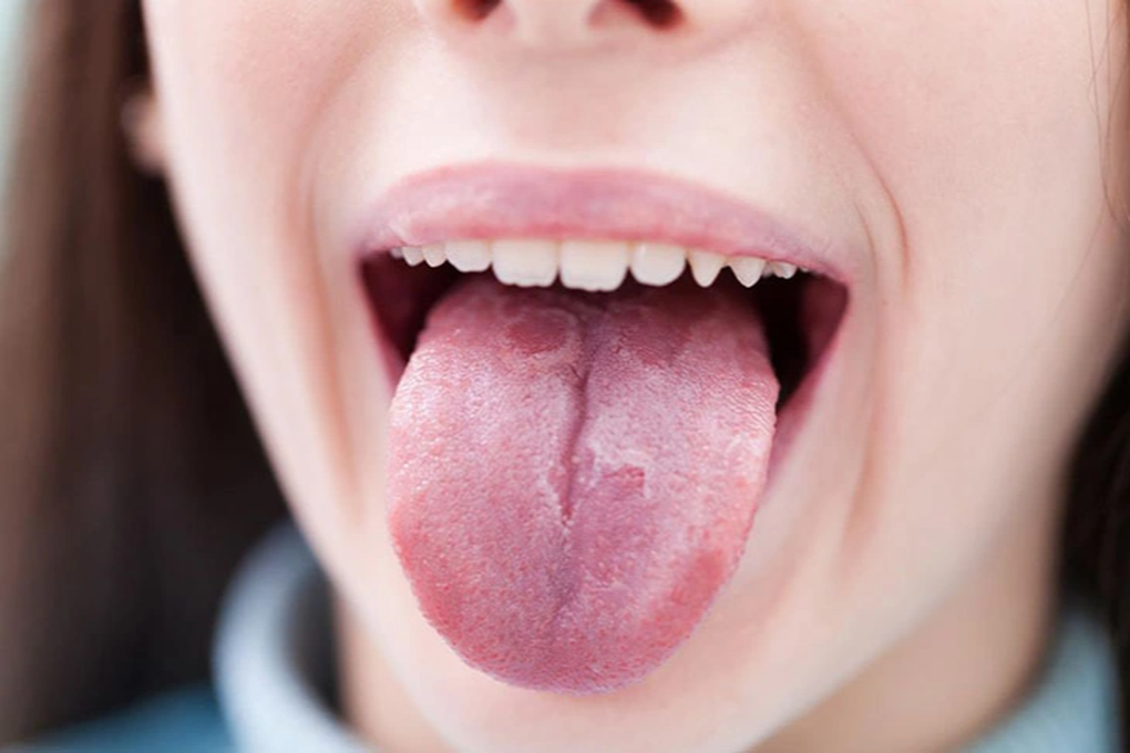 6 dấu hiệu cảnh báo ung thư lưỡi giai đoạn muộn - 1 6 dấu hiệu cảnh báo ung thư lưỡi giai đoạn muộn - 1