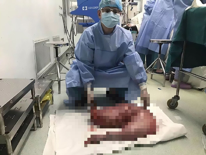 Bị táo bón bẩm sinh, anh chàng khiến các bác sĩ tá hỏa khi phẫu thuật cắt đoạn ruột chứa 13kg chất thải - Ảnh 2. Bị táo bón bẩm sinh, anh chàng khiến các bác sĩ tá hỏa khi phẫu thuật cắt đoạn ruột chứa 13kg chất thải - Ảnh 2.
