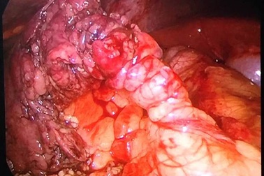 Đau bụng âm ỉ, nam thanh niên tá hỏa khi thấy mạc nối lớn xoắn như lò xo trong bụng