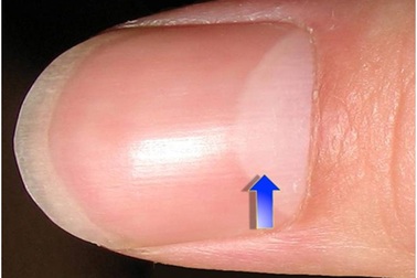 Nhận biết tình trạng sức khỏe nhờ hình bán nguyệt trên móng tay