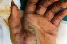 Nhập viện cấp cứu vì chơi pháo tự chế