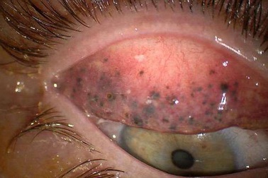 Người phụ nữ 25 năm không loại bỏ mascara chuốt mi và hậu quả đáng sợ