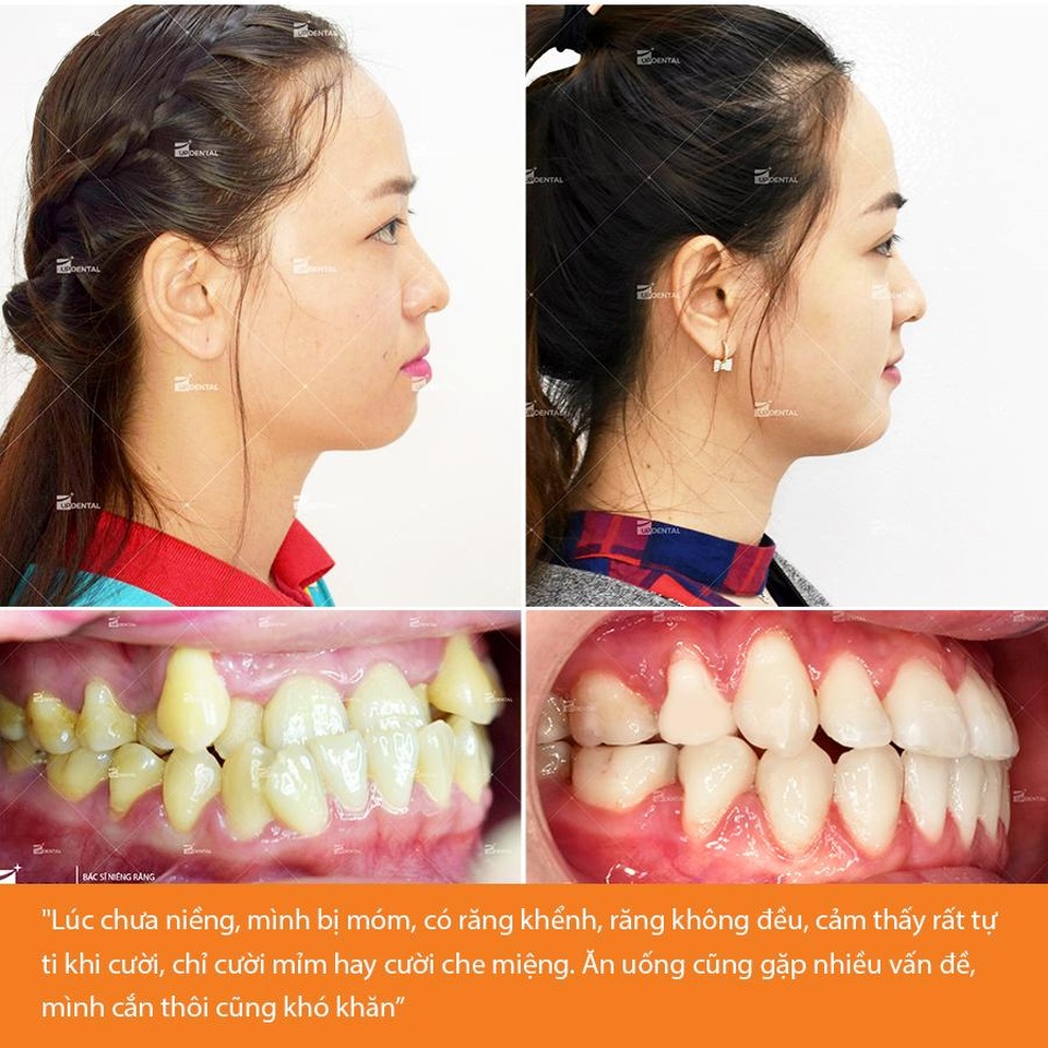 Quy trình niềng răng: Ngoạn mục cô chủ tiệm làm đẹp thay đổi sau 2 năm đeo niềng - 2