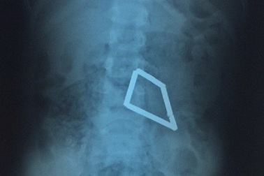 Bé trai bị thủng ruột vì 8 thanh nam châm xếp hình trong bụng