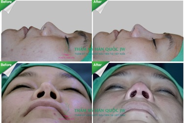 Nâng mũi Sline bằng Demoderm