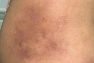 Người phụ nữ mưng mủ, chảy dịch mông vì tiêm filler