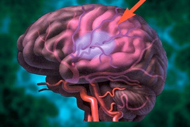 Tại sao tăng huyết áp lại dễ xảy ra tai biến?