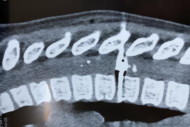 Súng hơi cướp cò, bé trai bị liệt nửa người