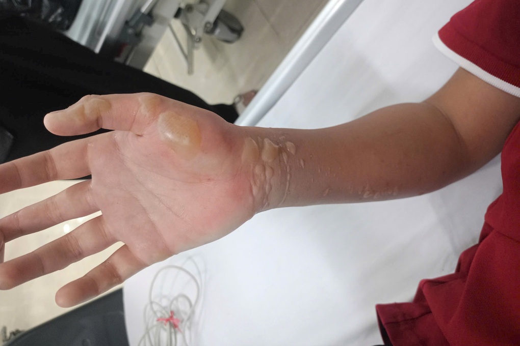 Tự đốt pháo, bé trai 12 tuổi bị bỏng nặng khắp người - 2