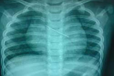 Bé 5 tuổi nuốt kim may quần áo vào bụng