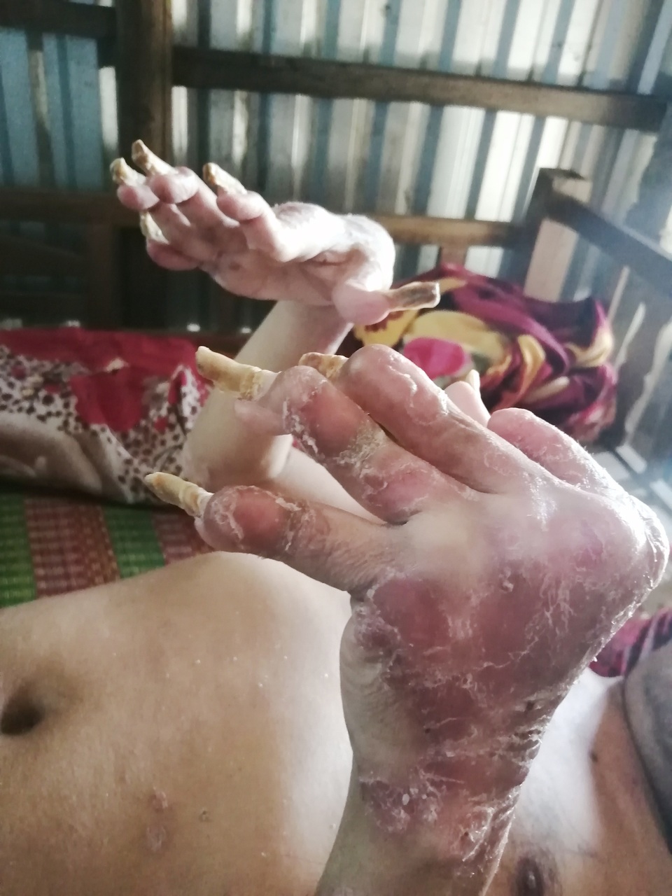 Sởn da gà cảnh người đàn ông vạm vỡ bị bệnh vảy nến quật ngã có bộ da như da cá sấu - 2 Sởn da gà cảnh người đàn ông vạm vỡ bị bệnh vảy nến quật ngã có bộ da như da cá sấu - 2