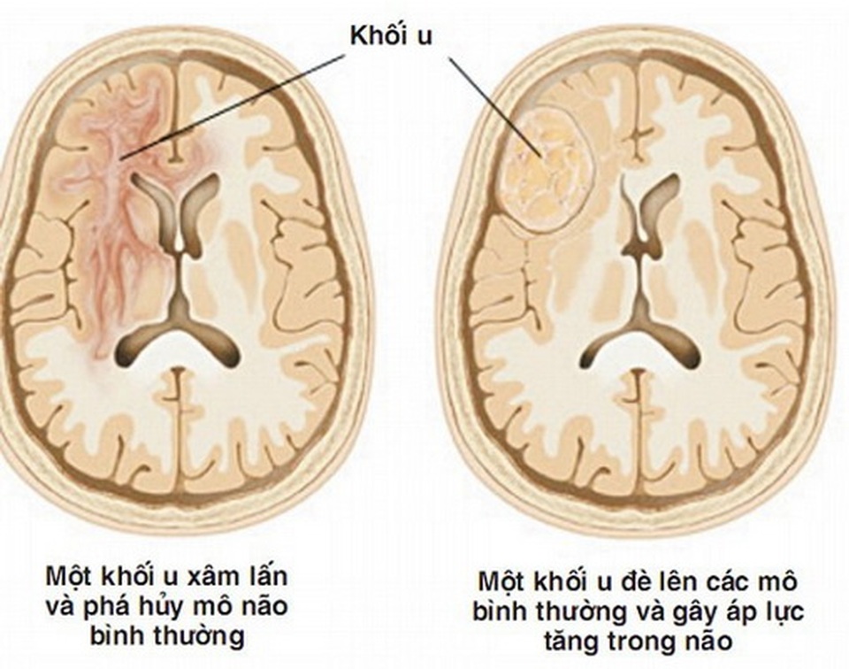 Dấu hiệu cảnh báo u não - 1 Dấu hiệu cảnh báo u não - 1