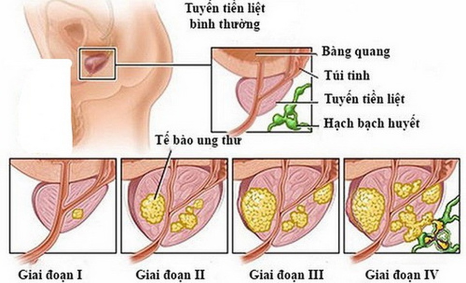 Rối loạn cương dương, tiểu ra máu- dấu hiệu cảnh báo ung thư ung tuyến liệt - 1 Rối loạn cương dương, tiểu ra máu- dấu hiệu cảnh báo ung thư ung tuyến liệt - 1