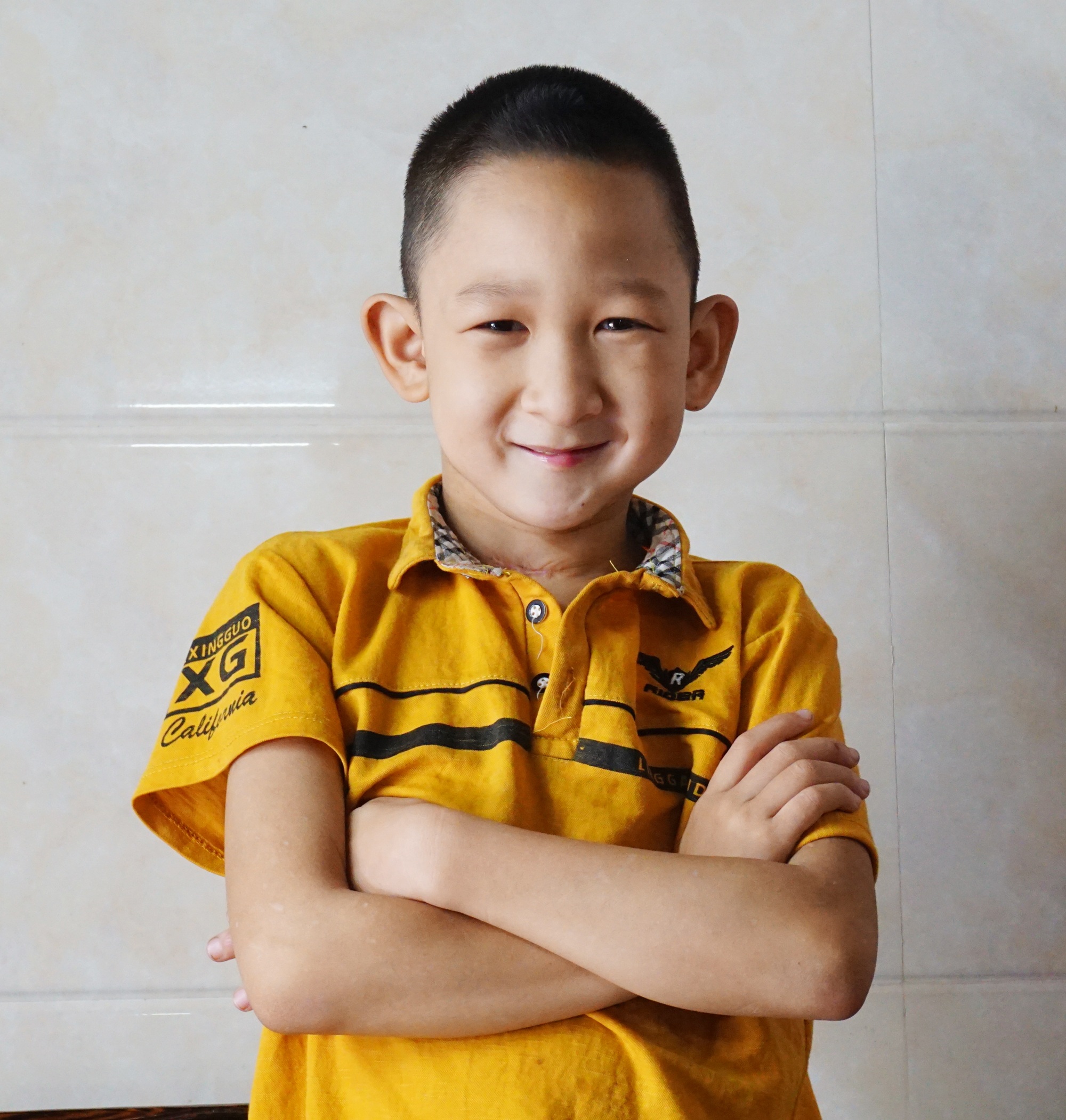 Hành trình hồi sinh đầy gian nan của cậu bé đa dị tật 2 lần bị bỏ rơi - 3 Hành trình hồi sinh đầy gian nan của cậu bé đa dị tật 2 lần bị bỏ rơi - 3