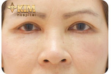 Thẩm mỹ mắt Midface: bí quyết lưu giữ thanh xuân cho tuổi trung niên