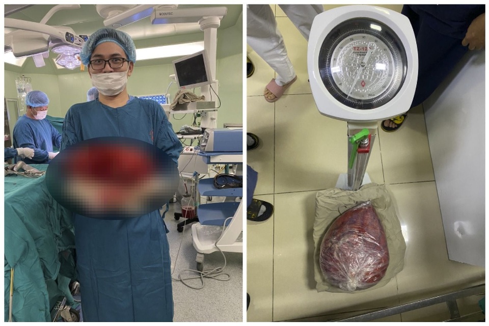 Sốc: Khối u 10kg trong bụng nữ bệnh nhân - 1